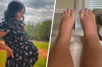 Отеки при беременности: скрытая угроза или обычное дело?