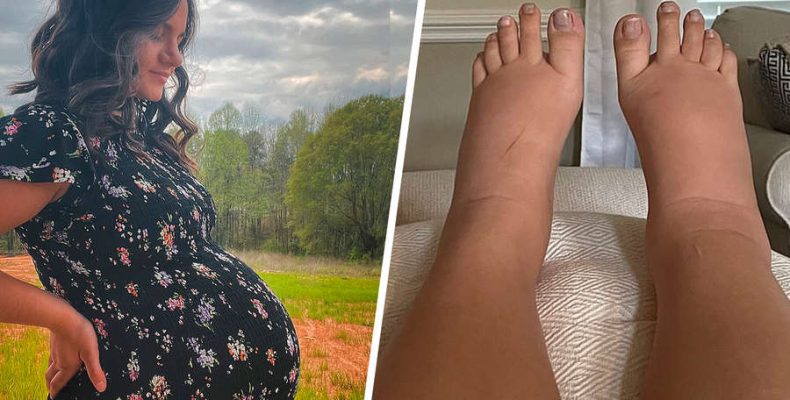 Отеки при беременности: скрытая угроза или обычное дело?